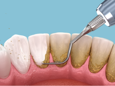 SRP（スケーリング＆ルートプレーニング）